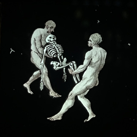 Miles J Paralysis